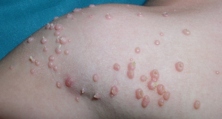 Molusco Contagioso