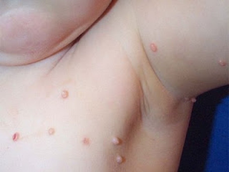 Molusco Contagioso