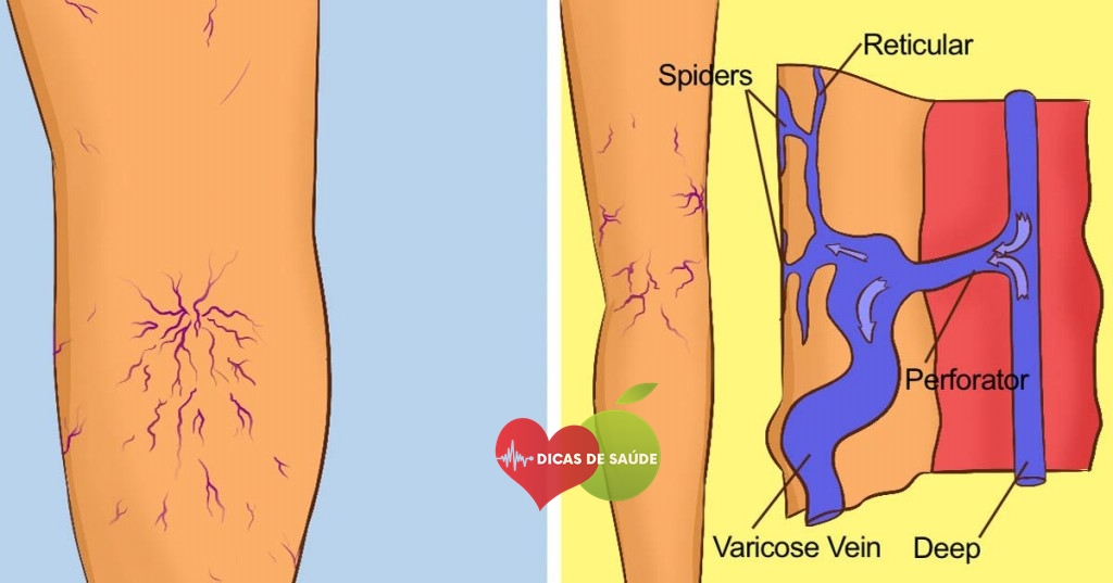 Os 12 Principais Sintomas da Varizes
