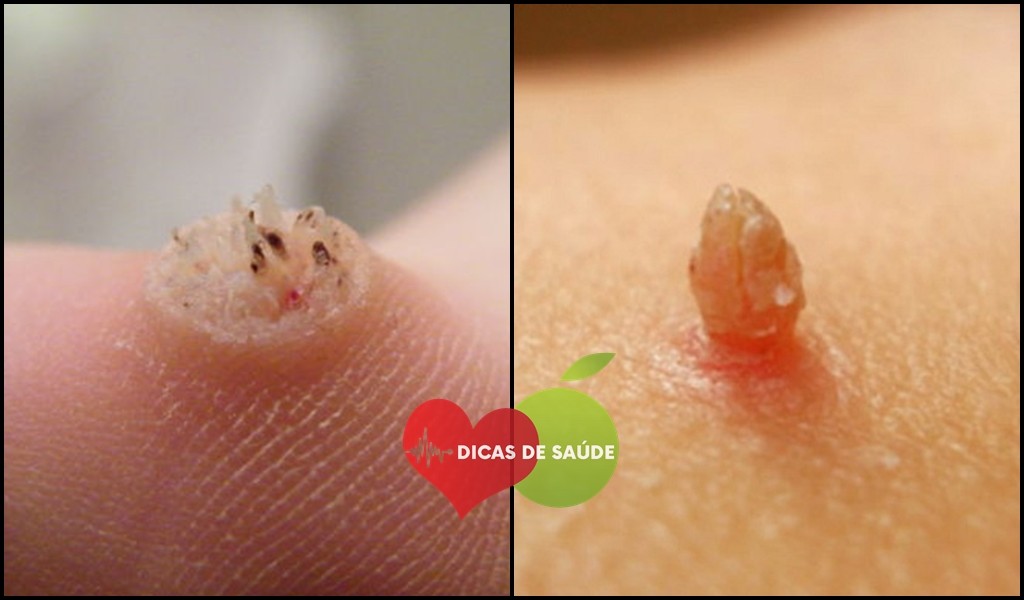 Os-12-Rem%C3%A9dios-Caseiros-Para-Remove