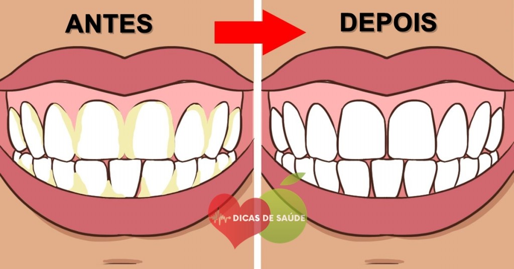 Placa Bacteriana nos Dentes
