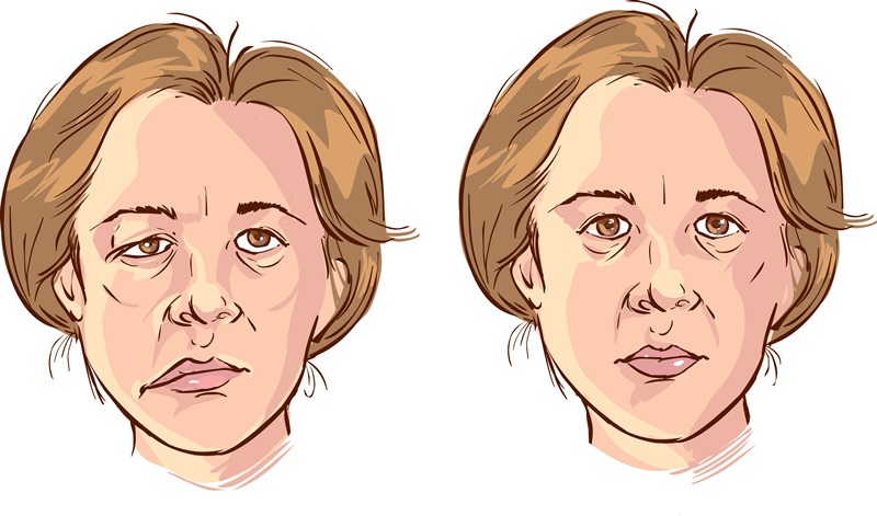 Paralisia Facial Causas