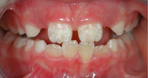 causas da perda de esmalte do dente