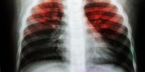 Remédios Caseiros Para Tratar a Tuberculose