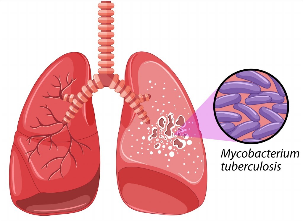 Remédio Caseiro Para Tratar a Tuberculose