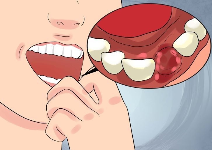 Sinais de Infecção Dentária e Como Tratar em Casa 1