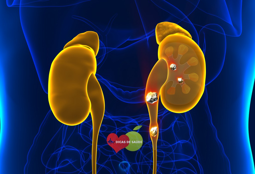 Sintomas de Pedras nos Rins