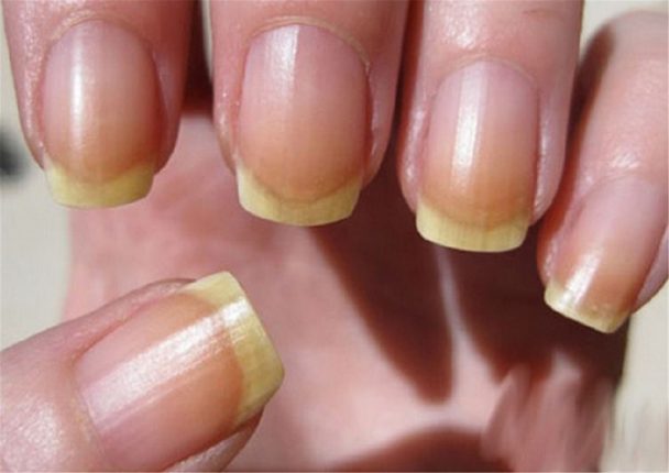 Síndrome das Unhas Amarelas - O que é, Sintomas e Tratamentos | Dicas ...