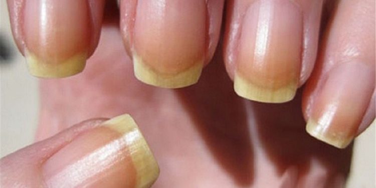 Síndrome das Unhas Amarelas – O que é, Sintomas e Tratamentos