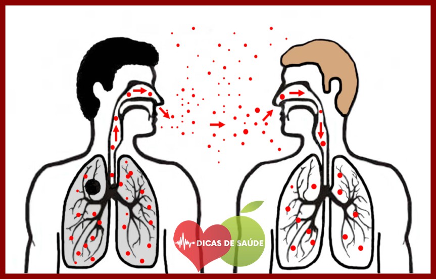 Tuberculose