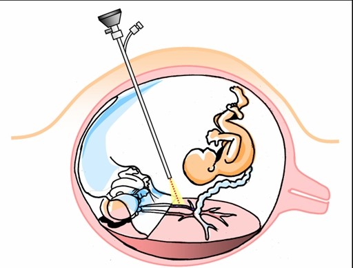 Uropatia Obstrutiva