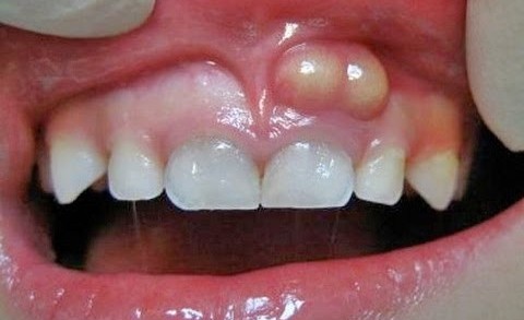 Sintomas de Abscesso Dentario