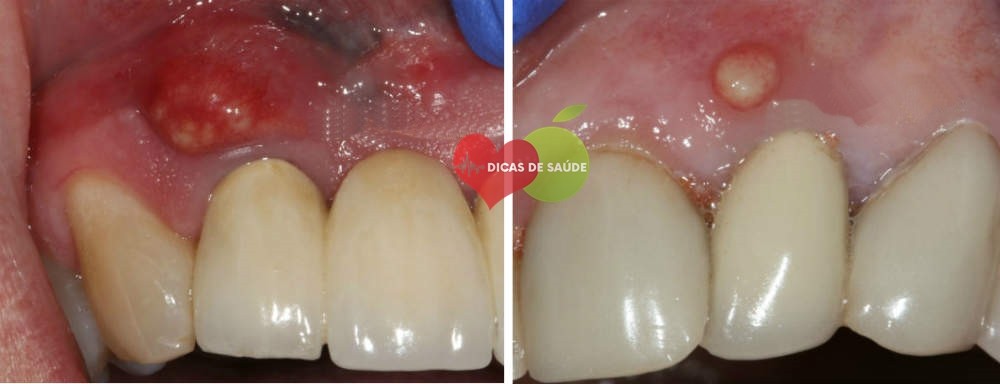 Abscesso Dentário