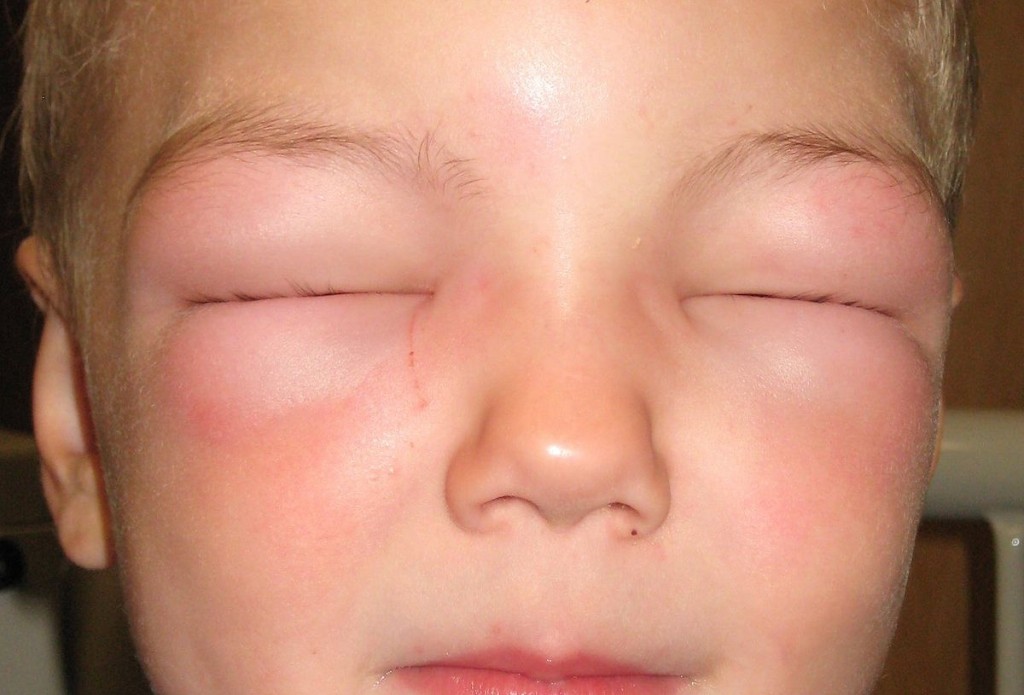 Angioedema