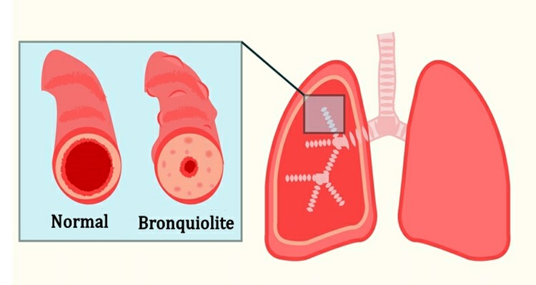 bronquiolite