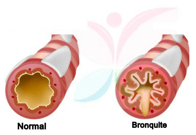 bronquite