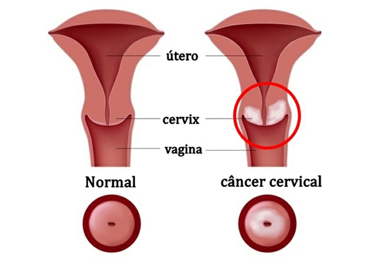 Câncer Cervical