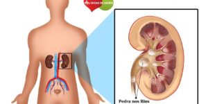 calculo renal-1