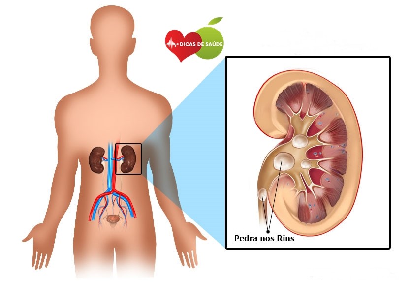 calculo renal-1