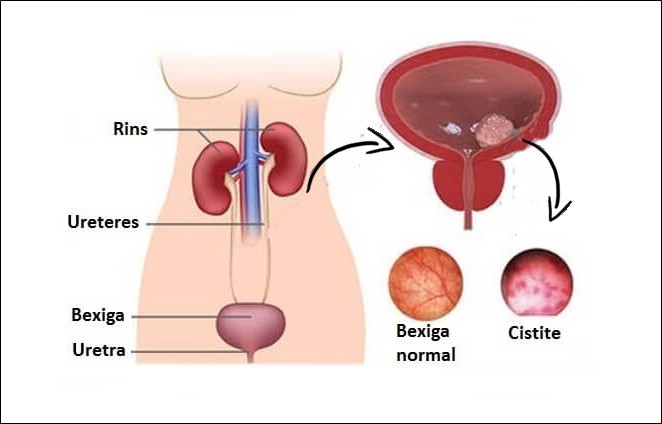 Cistite 