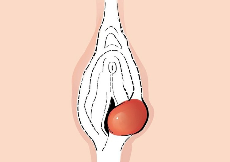 Cisto de Bartholin-1