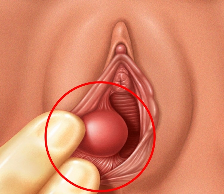 cisto de bartholin-4