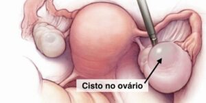 cisto de ovário-1