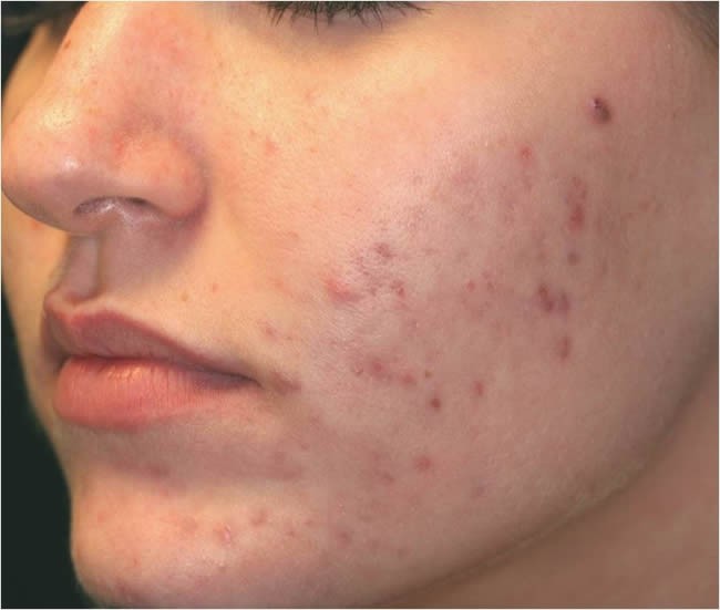 Coisas Sobre Acne