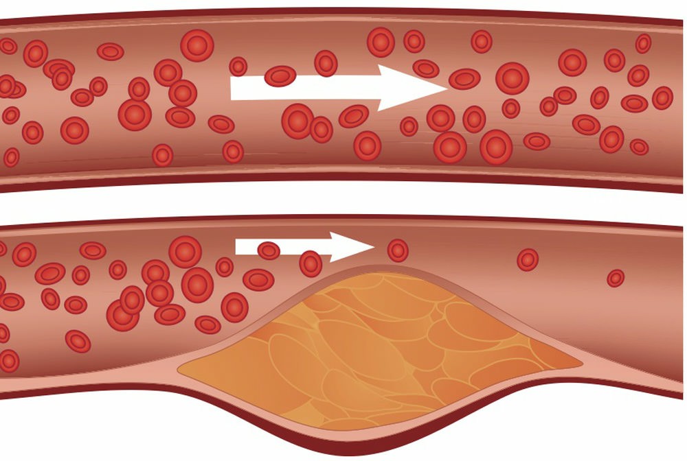 colesterol 1