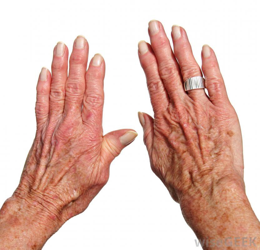 combater artrite