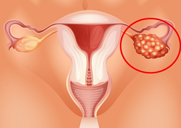 câncer de ovário 1