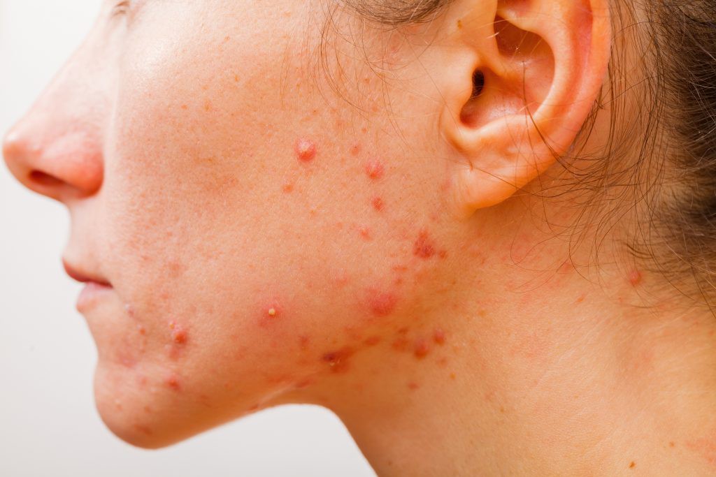 Chá de Malva Eliminar Acne