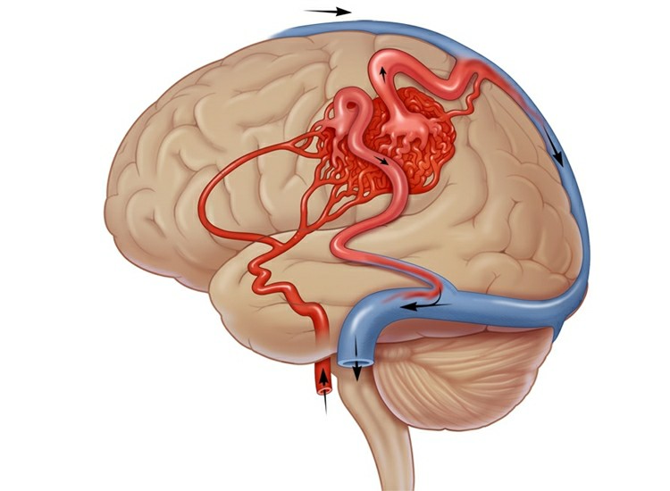 Malformação Arteriovenosa Cerebral
