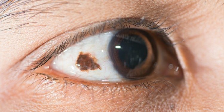 Melanoma Ocular – O que é, Sintomas e Tratamentos