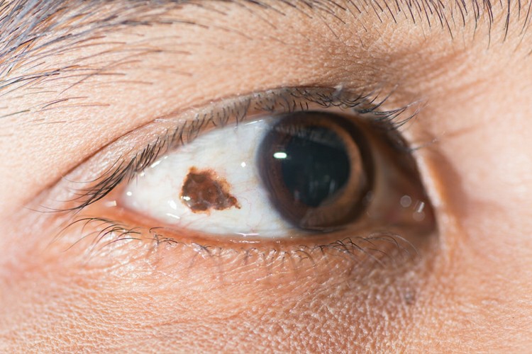Melanoma Ocular Melanoma Ocular