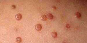 molusco contagioso