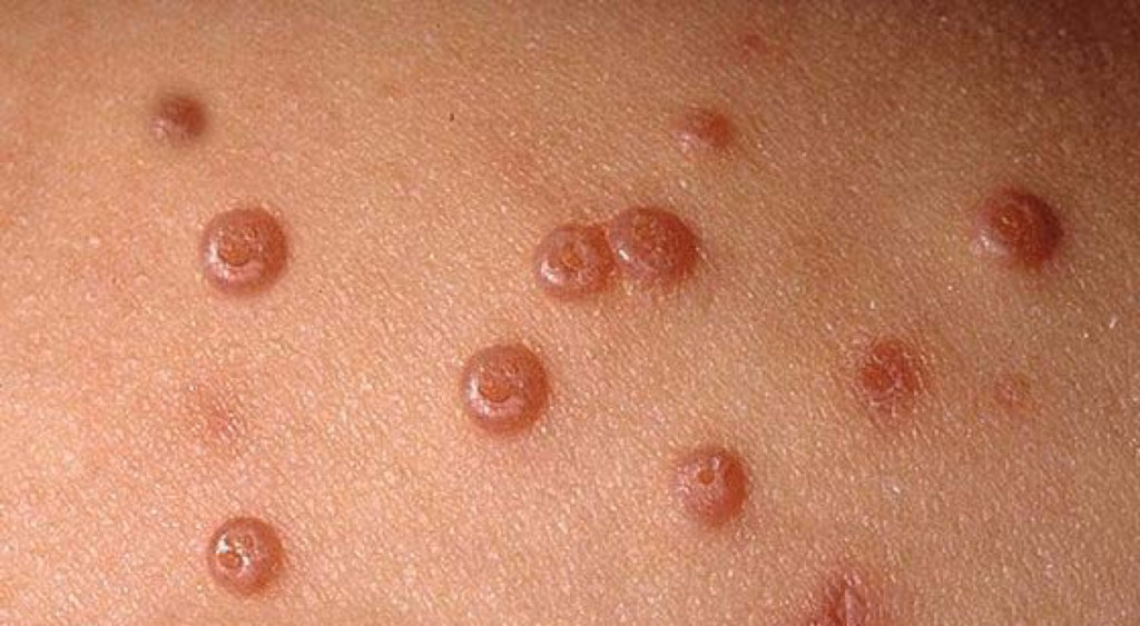 molusco contagioso