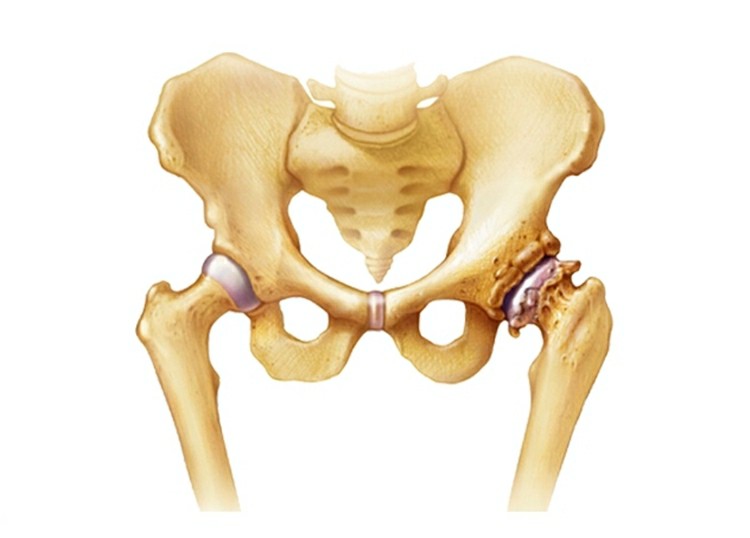 osteoartrite 1