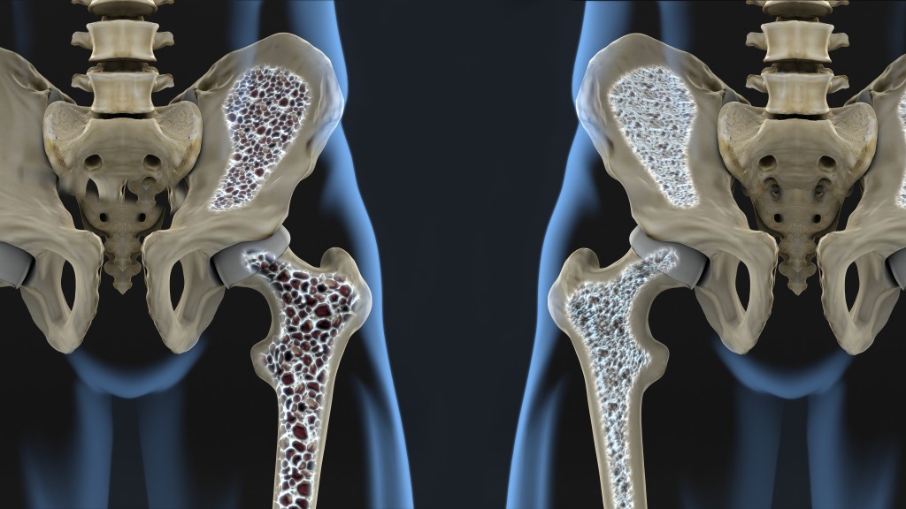 Remédio Caseiro Para Tratar Osteoporose