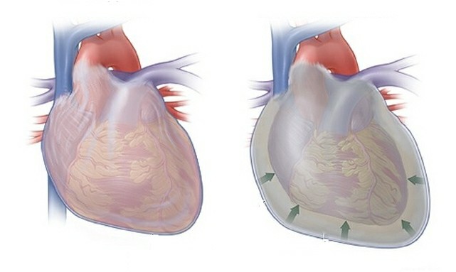 pericardite