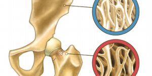 Remédio Caseiro Para Tratar Osteoporose