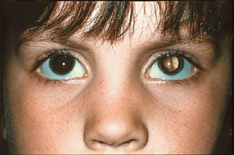 Retinoblastoma