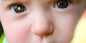 Retinoblastoma