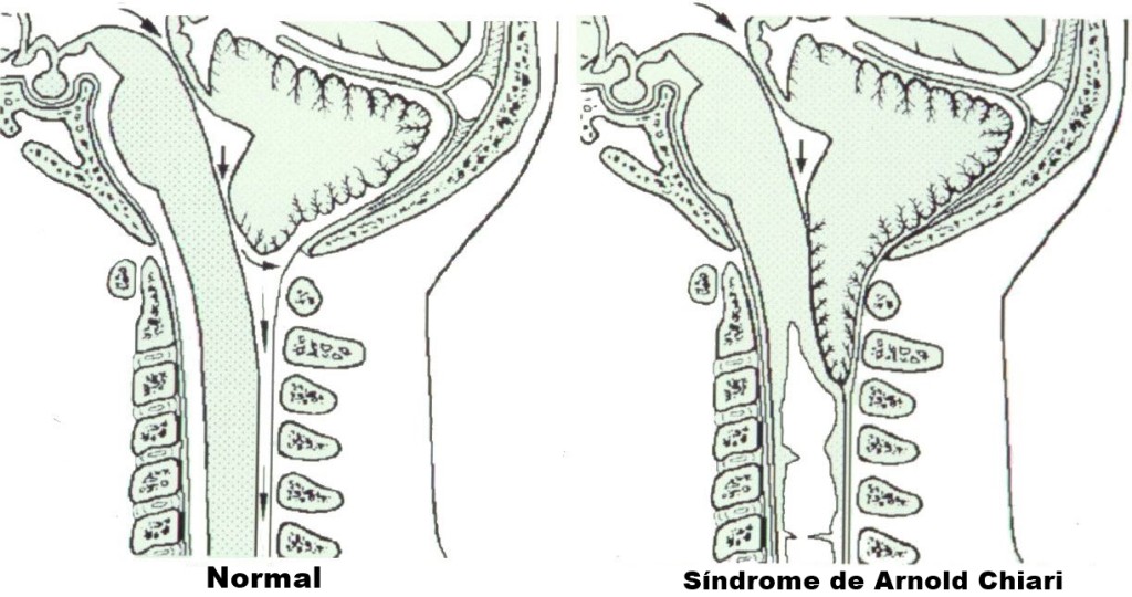 Síndrome de Arnold Chiari 