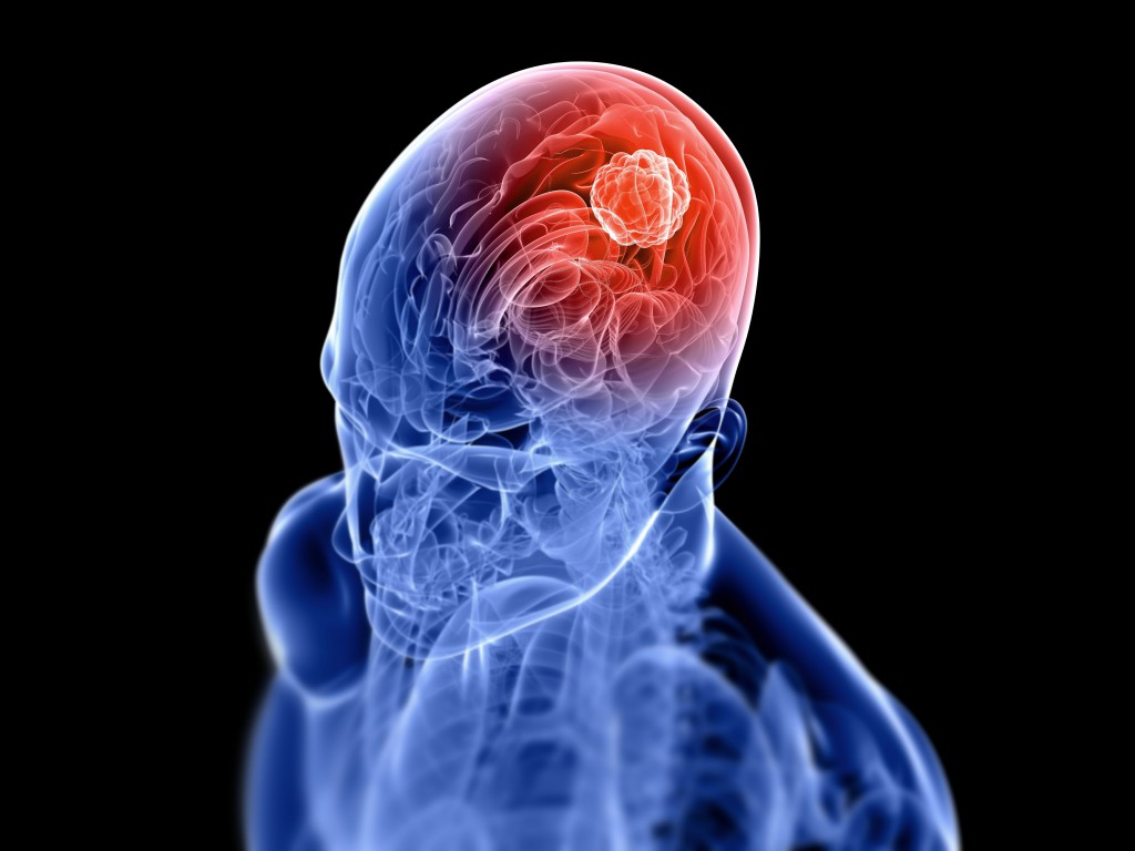 tumor no cerebro