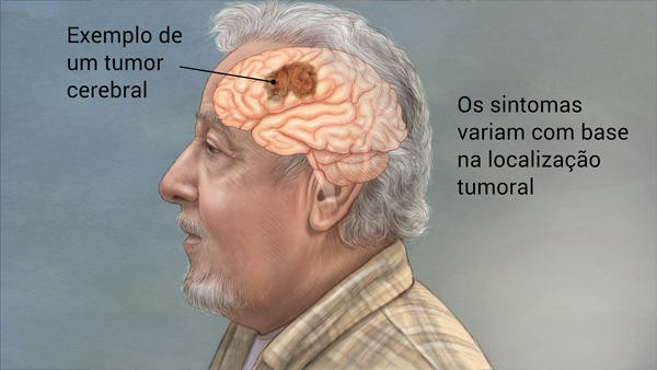 tumor cerebral