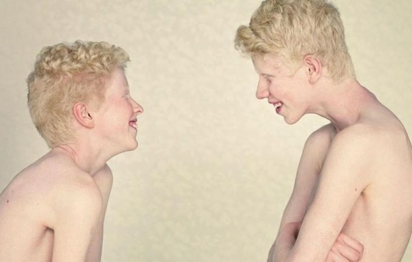 Tipos de Albinismo