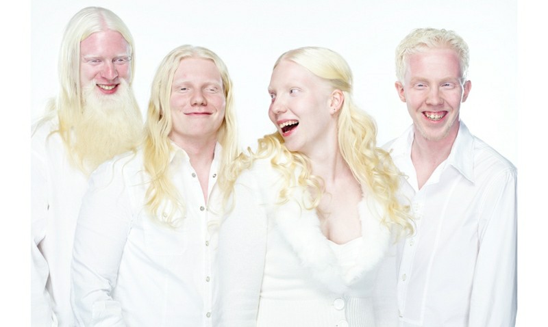 Albinismo 7