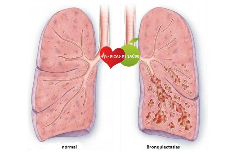 Bronquiectasia