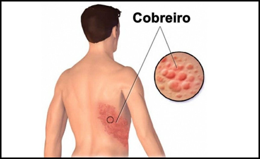 Sintomas de Cobreiro